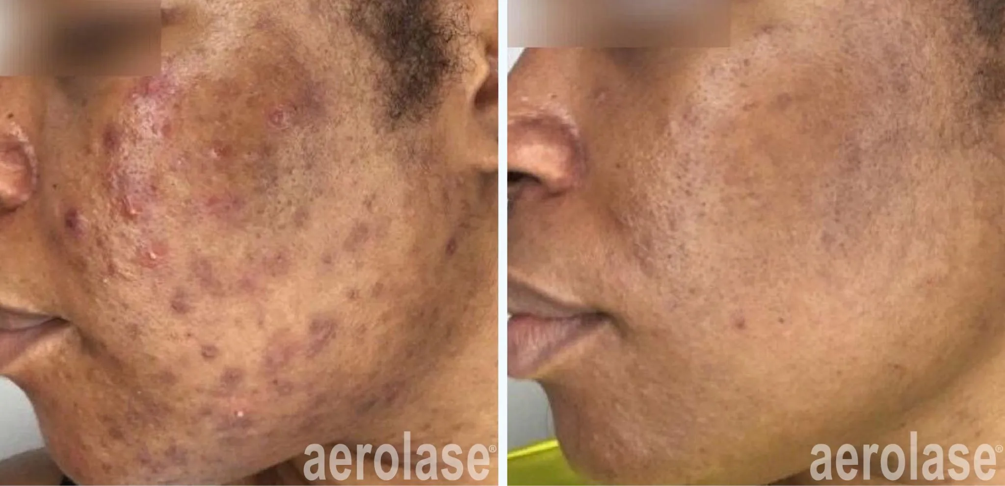 111acne-cheeks-sholema-skinofcolor-before-and-after-1-2048x991