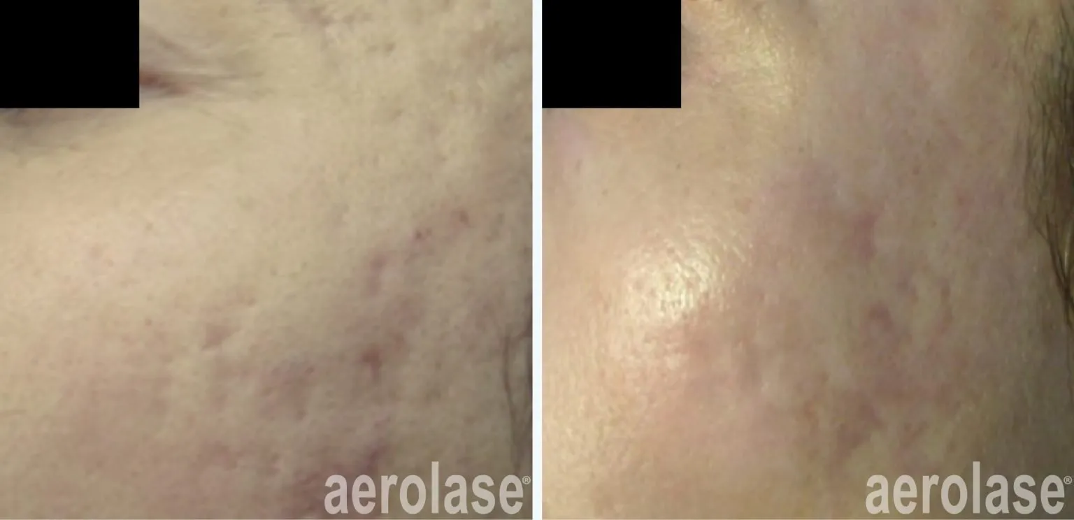 111acne-scars-viktor-moiseey-before-and-after-1536x744