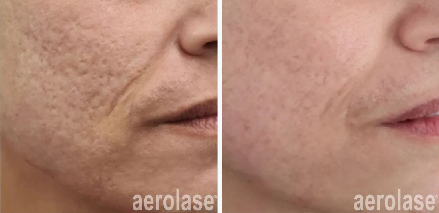 111acne-scars-watfa-before-and-after-1536x744