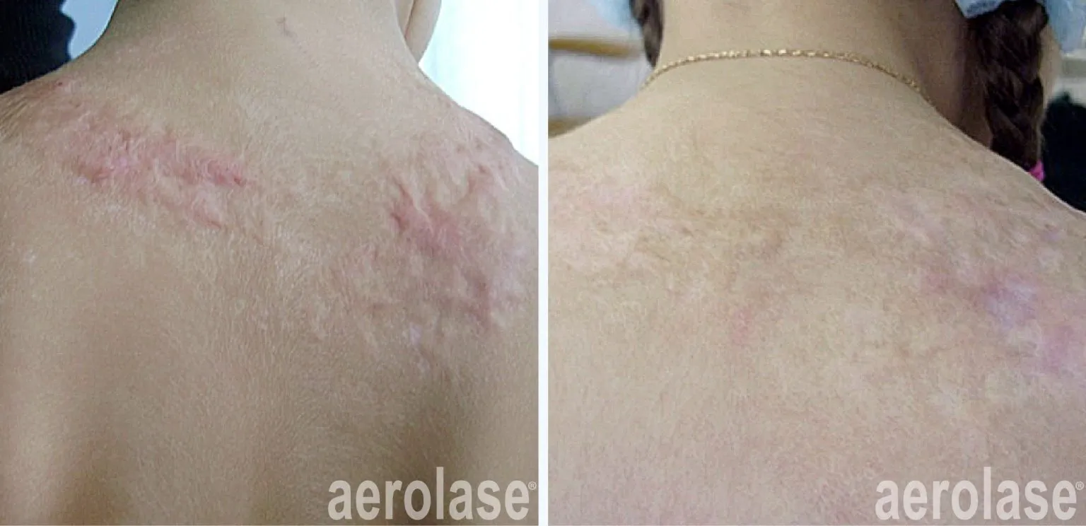 111burn-scar-drzoyaklimova-before-and-after-1536x744