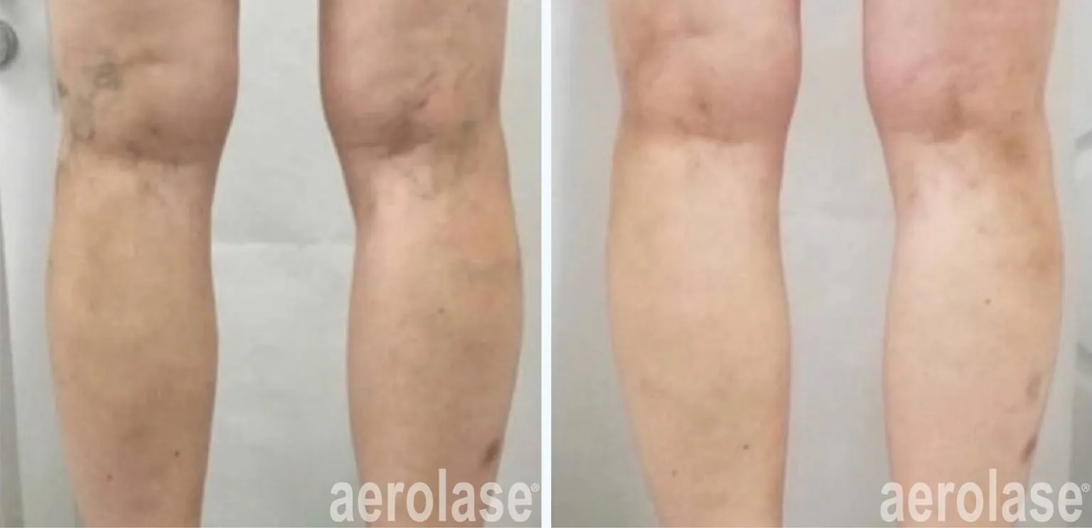 111leg-veins-drdmitrir-before-and-after-1536x744