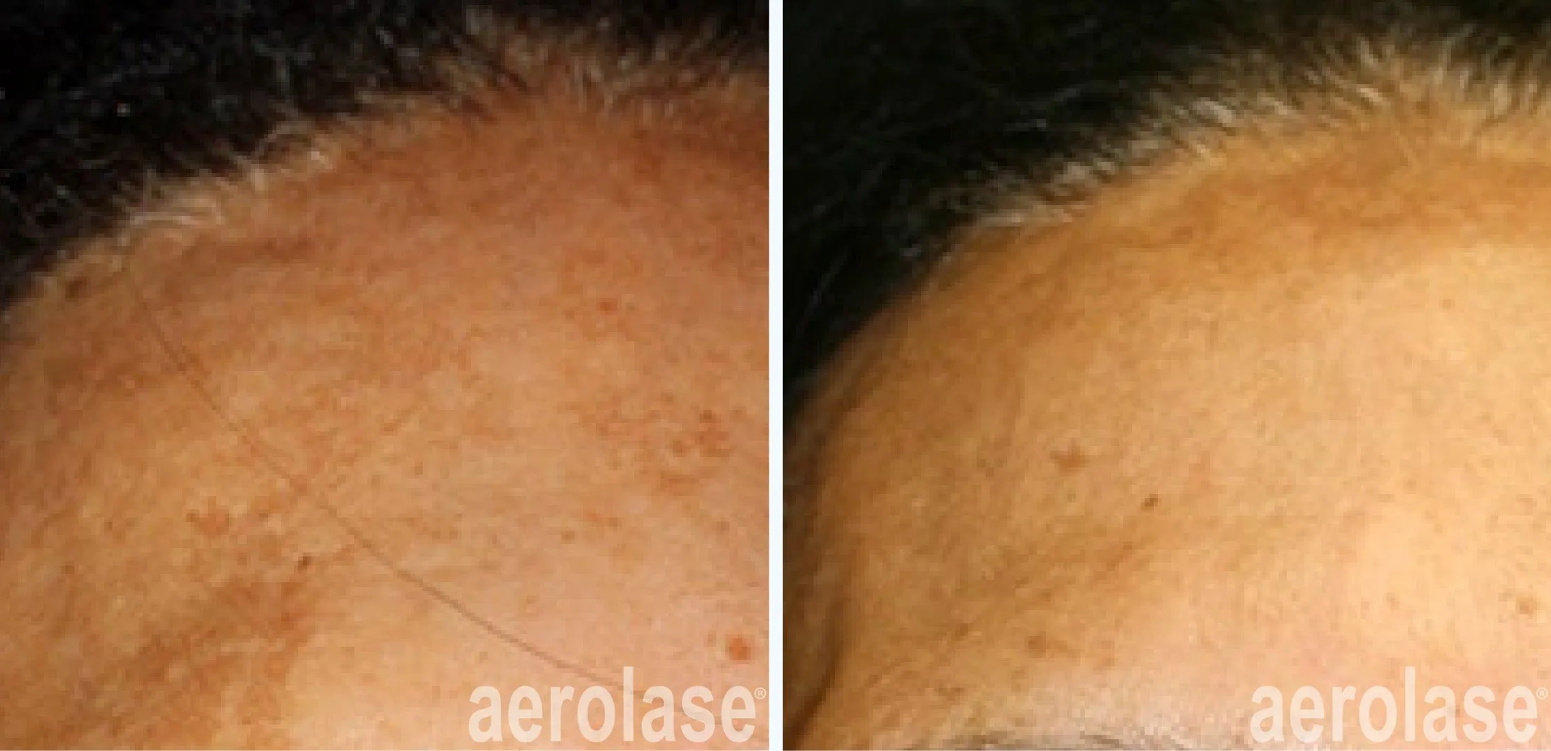 111melasma-3-cheryl-burgess-before-and-after