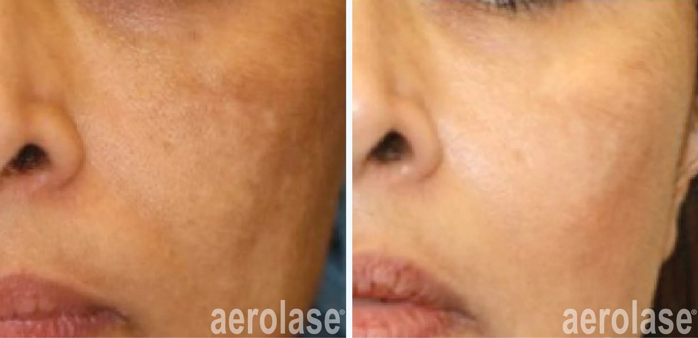 111melasma-cheryl-burgess-before-and-after
