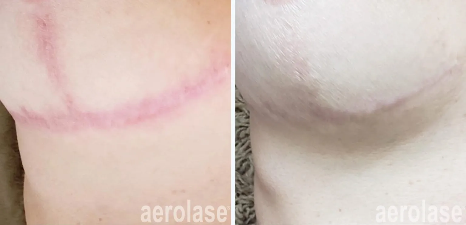 111post-surgical-scar-2-before-and-after-1536x744