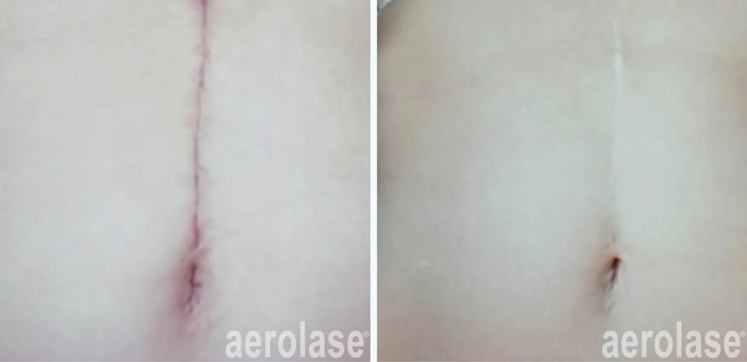 111post-surgical-scar-before-and-after-1536x744