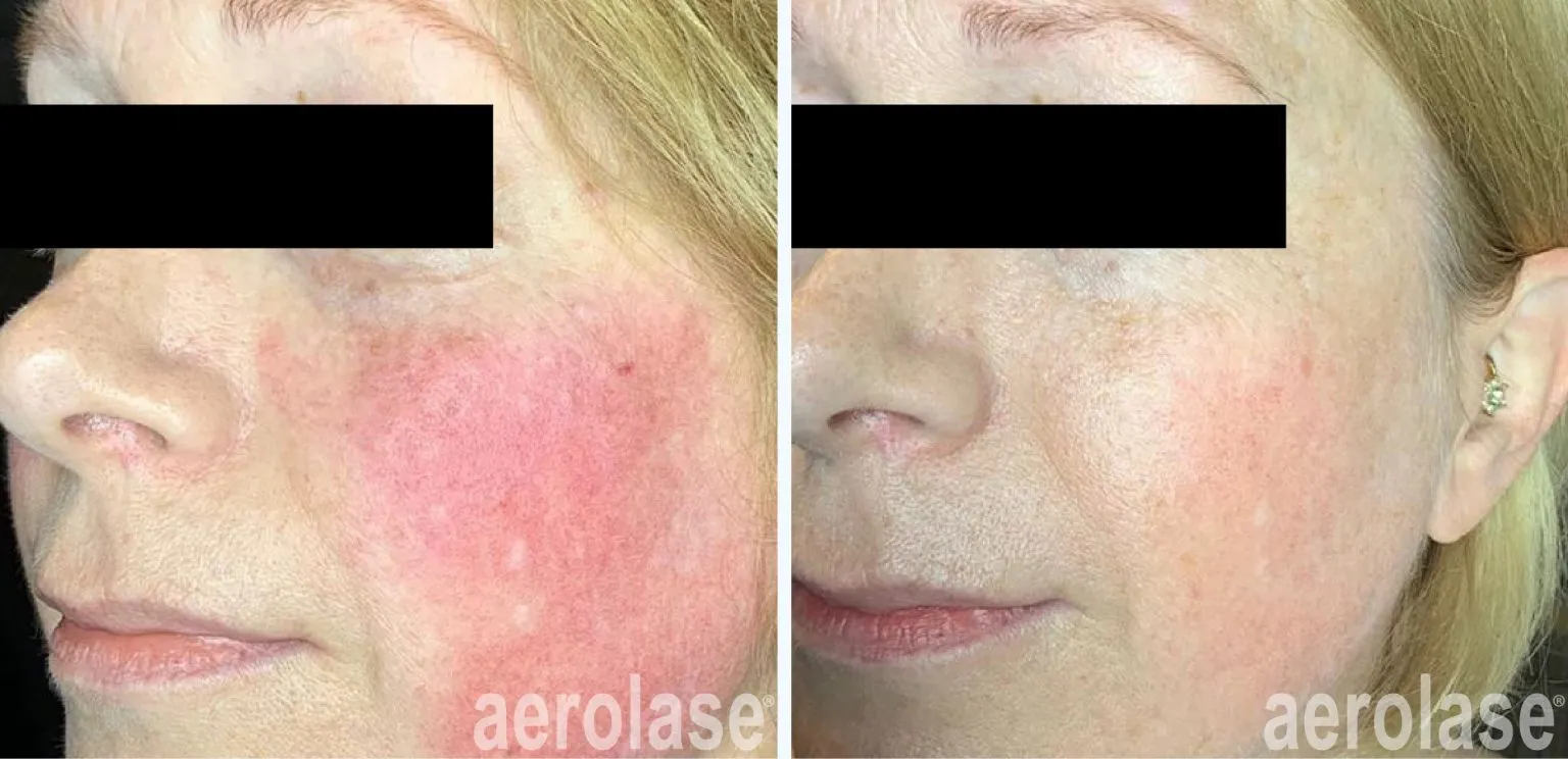 111rosacea-dermbarmd-before-and-after-1536x744