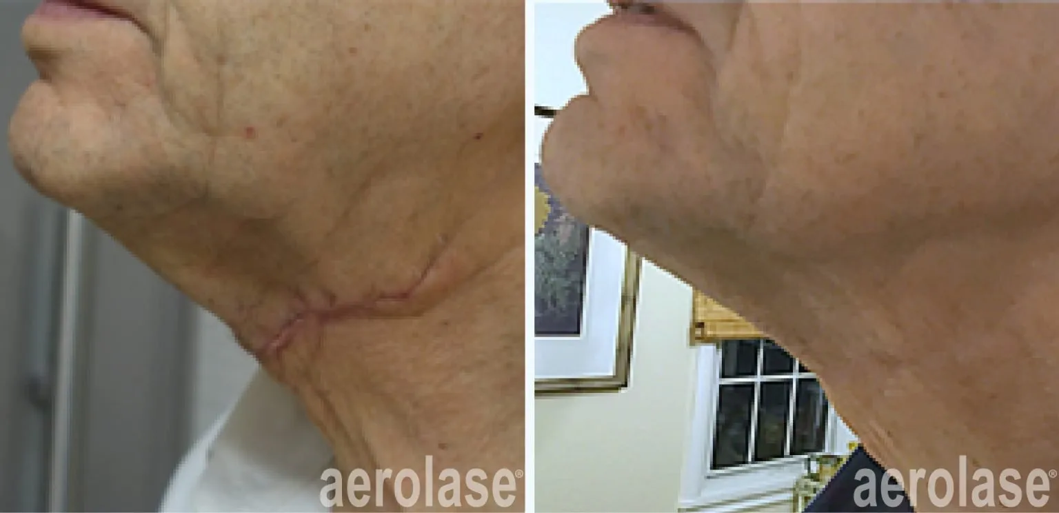 111surgical-scar-before-and-after-1536x744