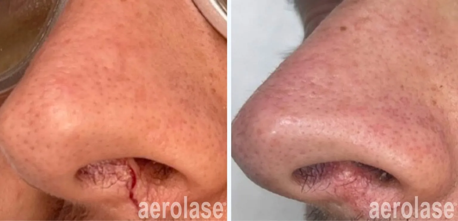 111veins-musemodernmedspa-before-and-after-1536x744