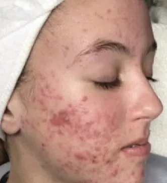 aerolase acne before and after