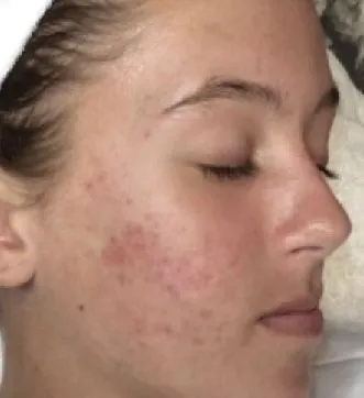 aerolase before and after acne 2