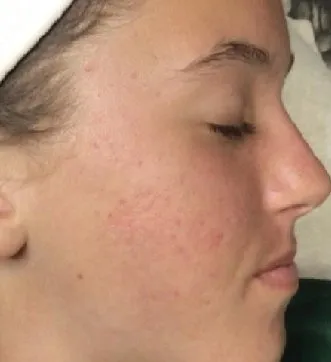 aerolase before and after acne 3