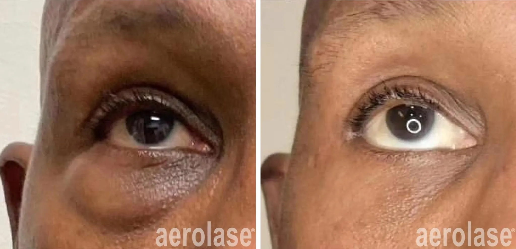 pigmentation-and-lower-eyelid-surgery-camille-cash-md-2048x991
