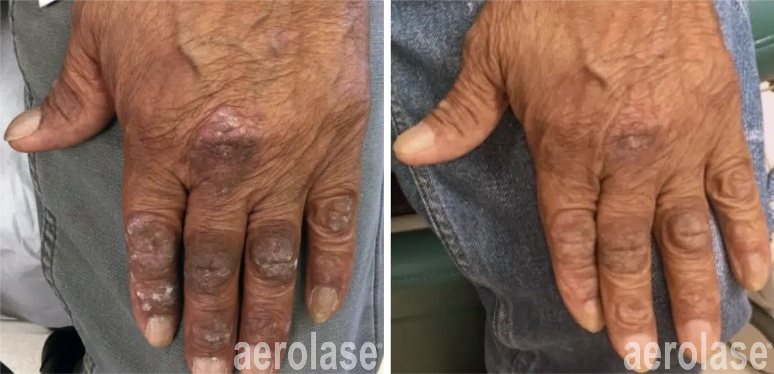 psoriasis-before-and-after-1-1536x743