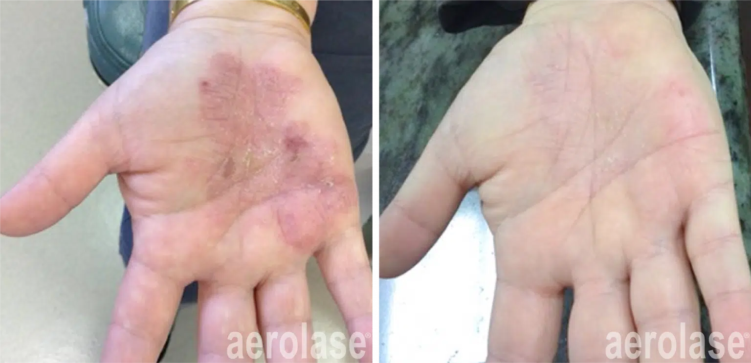 psoriasis-before-and-after-2-1536x743