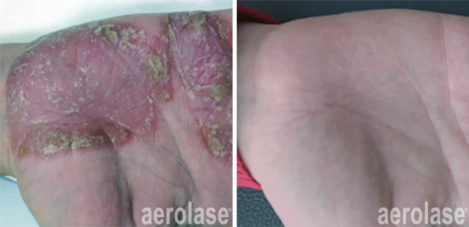 psoriasis-before-and-after-3-1536x743